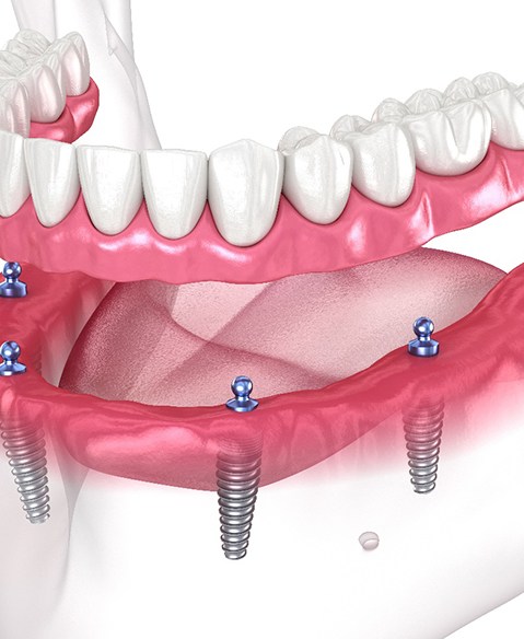 diagram of All-on-4 dental implants