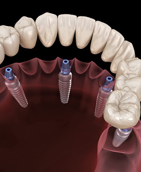 diagram of prosthetic teeth attaching to All-on-4 implants