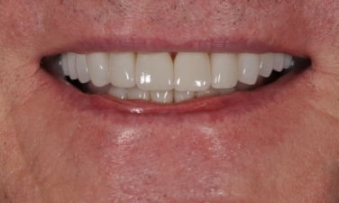 Flawless healthy smile closeup after cosmetic dentistry
