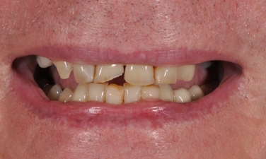 Damaged and discolored teeth closeup before cosmetic dentistry