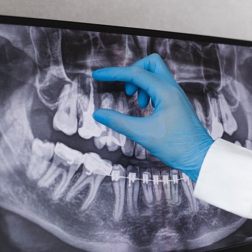 Dentist pointing to a patient’s dental root on an X-ray