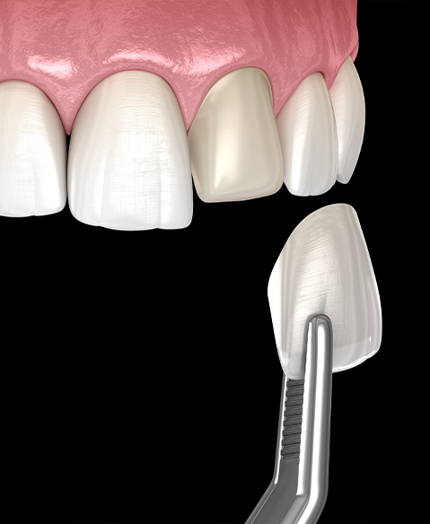 Animated smile during porcelain veneer cosmetic dentistry treatment