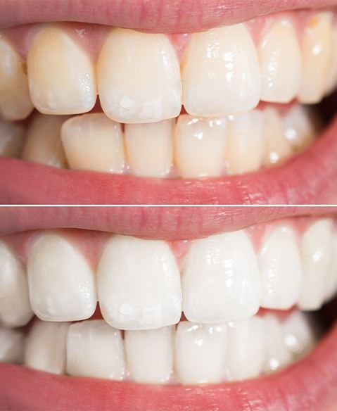 Smile before and after teeth whitening