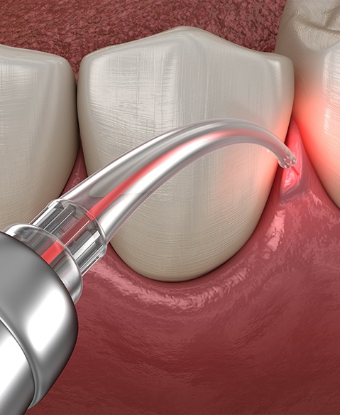 Animated smile during laser gum recontouring treatment