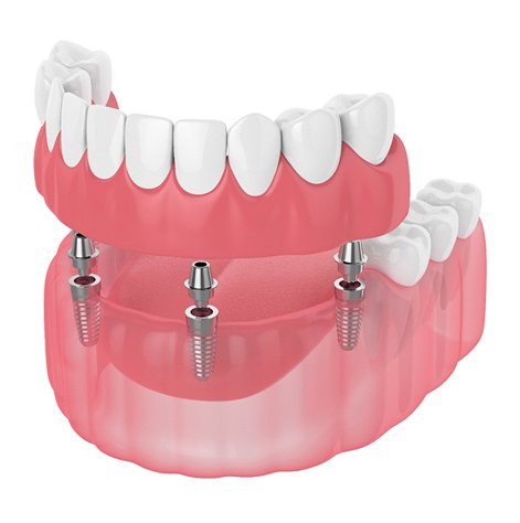 Diagram showing implant dentures in Fayetteville