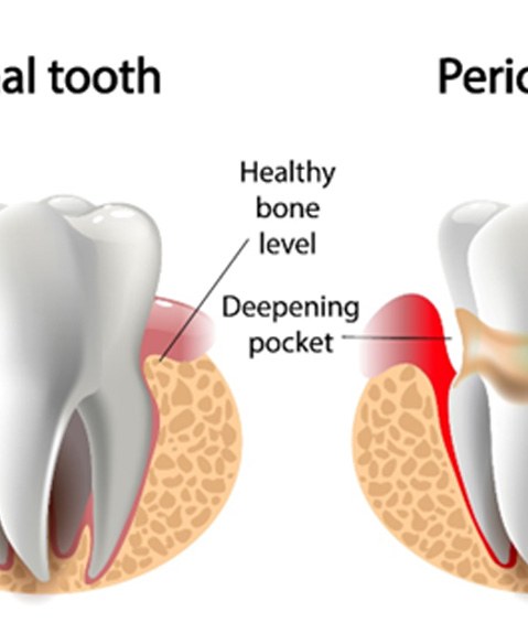 diagram showing what gum disease is 