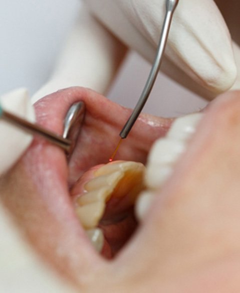 closeup showing the use of a soft tissue laser on gums    