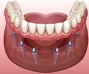 Diagram depicting the parts of dental implants in Fayetteville