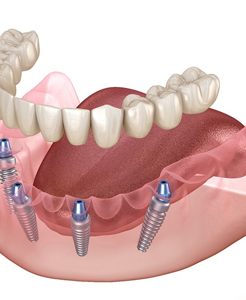 diagram of implant dentures