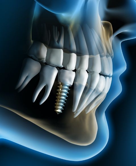 Animated smile with dental implant in Fayetteville