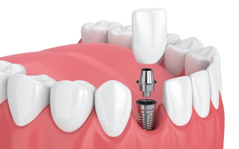Animated dental implant supported dental crown placement