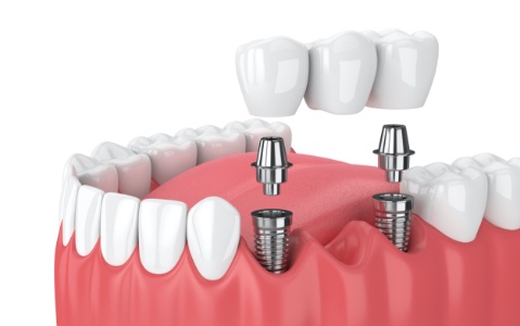 Animated smile during dental implant supported fixed bridge placement