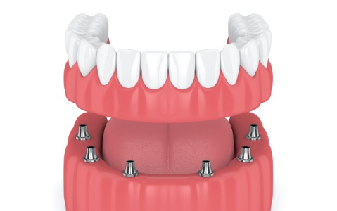 Animated smile during dental implant supported denture placement