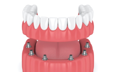 Animated smile during dental implant supported denture placement