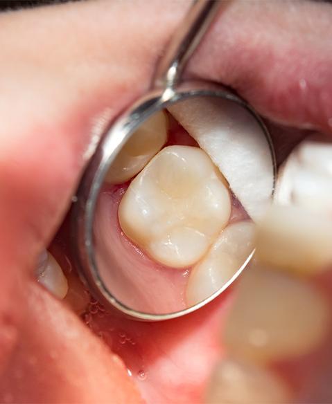 Closeup of smile during dental exam