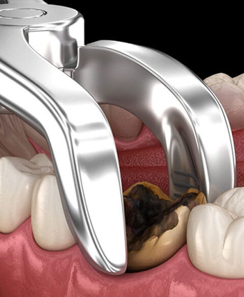 diagram of dental pliers extracting a decayed tooth