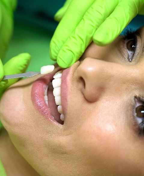 Dentist with green gloves applying veneer to patient's tooth