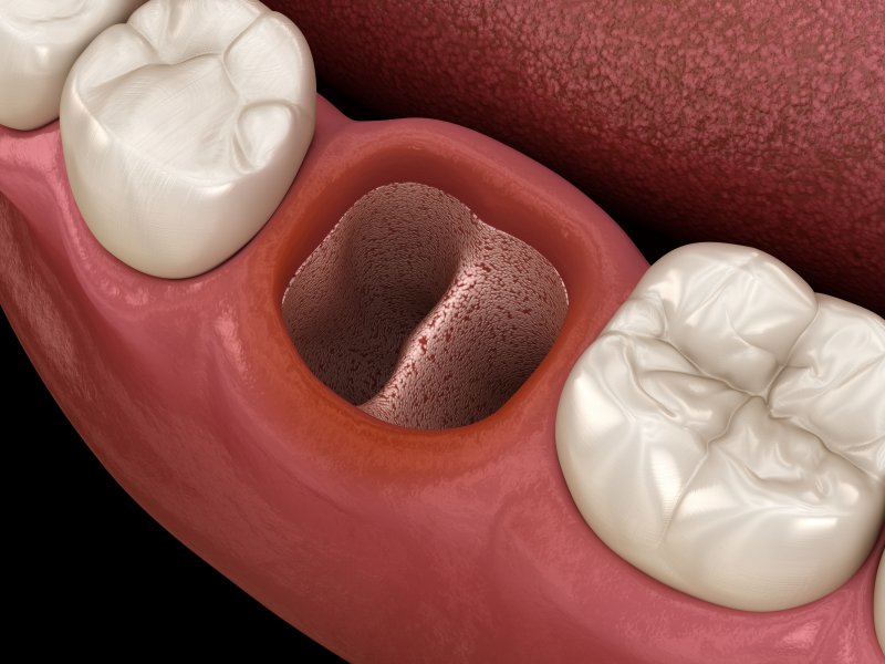 Vacated socket after tooth extraction 